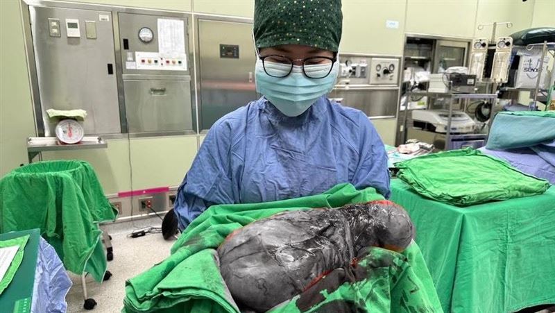 小腹瘦不了總被問「有了嗎」藏3.5kg巨瘤