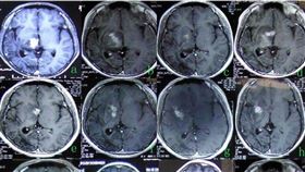 大陸,蛇膽,曼氏裂頭絛蟲,腦