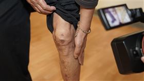 吳先生有高血壓、糖尿病及洗腎病史，日前起床後突然感覺腳嚴重疼痛、麻木無力，檢查為股動脈的急性栓塞造成肢體缺血症。（圖／新光醫院提供）