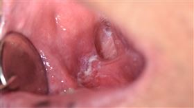 右側後臼齒區口腔癌，白斑清楚可見（圖／安南醫院提供）