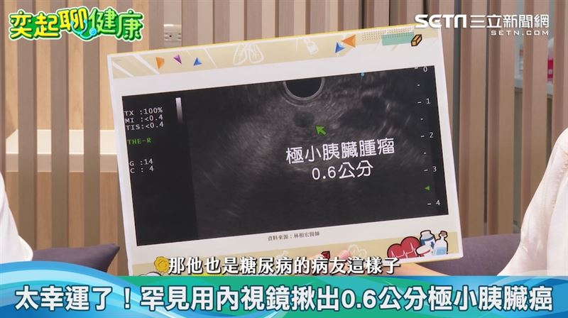 消滅癌王胰臟癌有效方法曝光　1招讓它滾