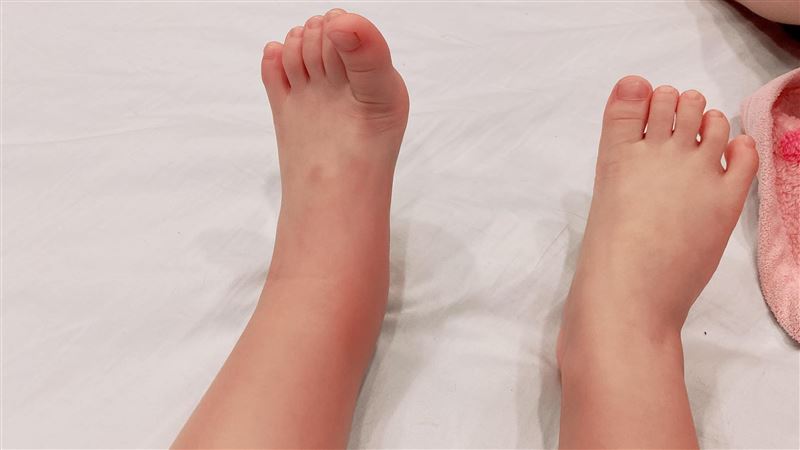 3歲童發燒掛急診　元凶竟是一雙「膠鞋」