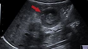 ０９０３腸套疊