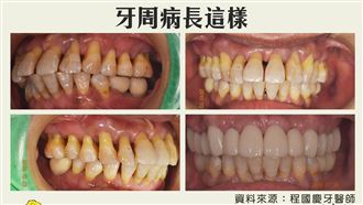 太恐怖了！牙周病沒治好癌症中風恐奪命