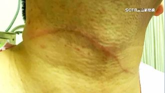 騎士下班「脖子刺痛」　遭釣魚線繞脖割傷