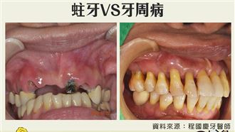 牙周病8個恐怖途徑曝光  4招預防快學起來
