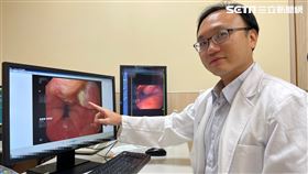 食道癌,巴瑞特氏食道(圖/亞大醫院提供)