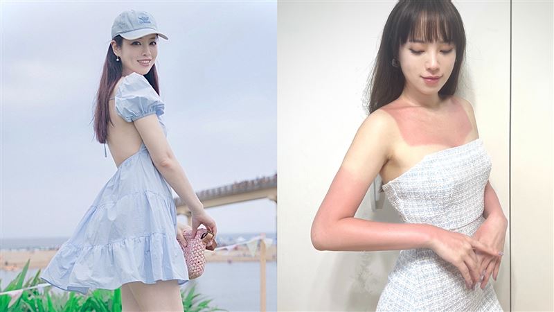 女星外景曬傷　白皙肌慘變「超人力霸王」