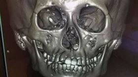 18歲少年罹患罕病，右臉變形萎縮，整形外科，顯微自體脂肪移植(圖／光田醫院提供)