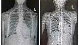 少女罹患馬凡氏症候群。（圖／翻攝自都市快報）