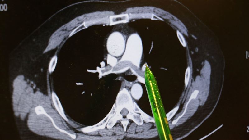男不菸不酒 上班久坐、躺沙發誘發肺栓塞