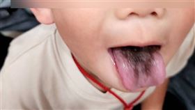 台中4歲男童，服用抗生素10天，長出「恐怖黑毛舌」(圖／光田醫院提供)