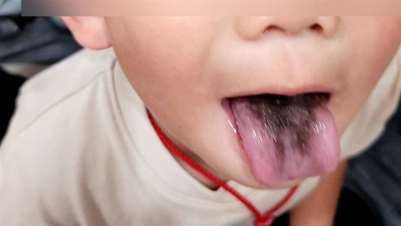 4歲男童舌頭長「恐怖黑毛」 媽嚇壞求診