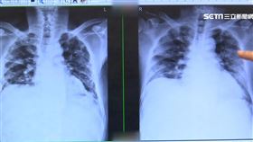 武漢肺炎痊癒後遺症? 首例出現肺纖維化
