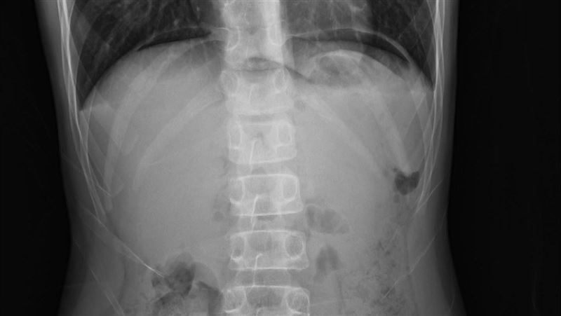 痛到蜷曲！醫摸女童腹部硬如木板　病因曝