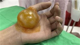 水泡,燙傷,衛福部(衛生福利部臺北醫院 臉書)