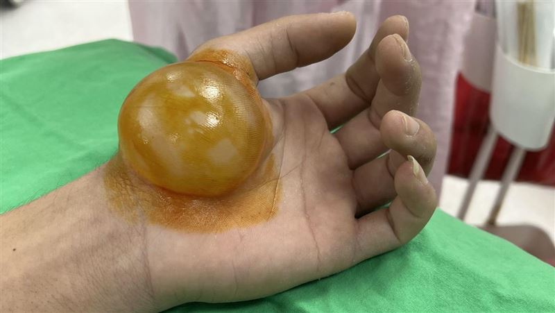 男燙傷「水泡跟手臂一樣寬」1原因難就醫