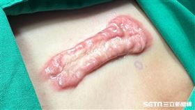 粉刺變油條疤／受訪者提供