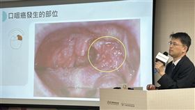廖立人提及，近年歐美地區口咽癌正在取代子宮頸癌，成為最常見的HPV相關癌症。（圖／記者簡浩正攝影）