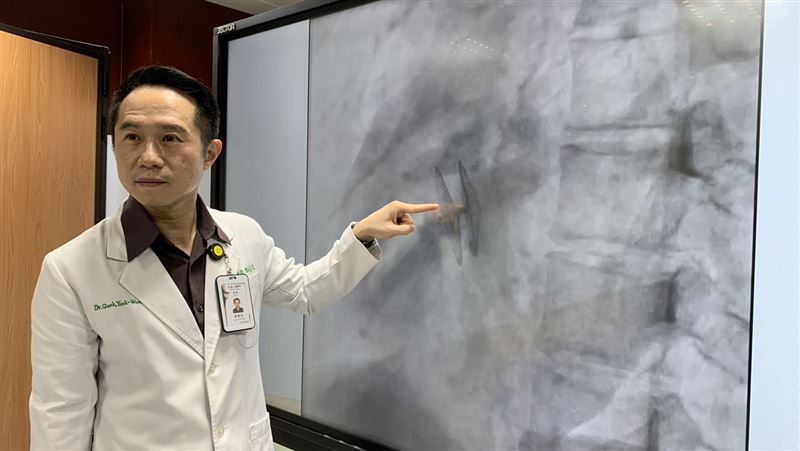 心臟卵圓孔未閉合　20歲女大生突發腦中風