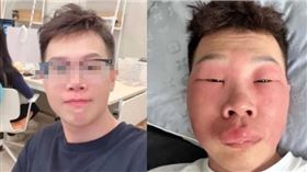 男子因「丹毒」感染，全臉發痛腫脹到眼睛都睜不開。（圖／翻攝自微博／中國網看點）