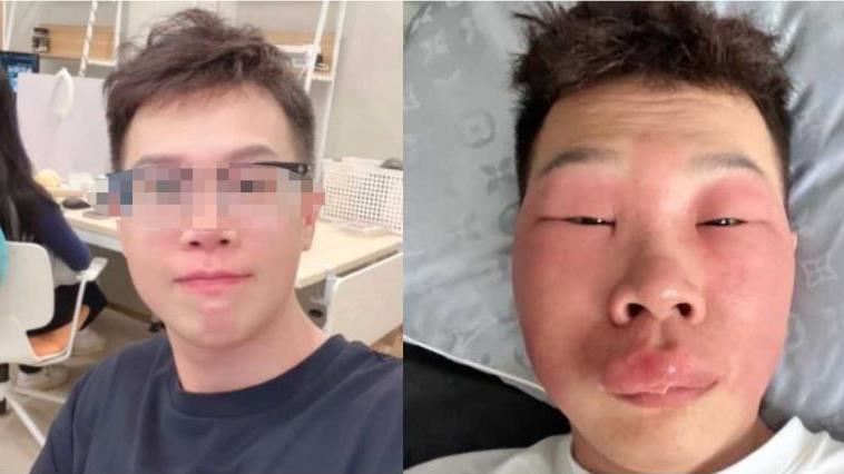 愛挖鼻孔？他「丹毒」感染臉腫到沒人認得