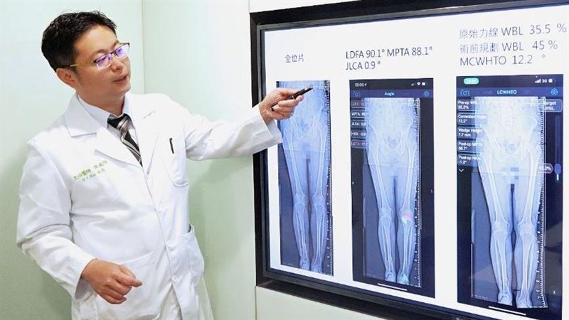 「3D列印技術」矯正變形腳踝！翁根治舊疾