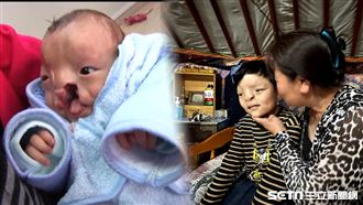 出生臉破大洞　男童：我不怪爸媽只怪自己