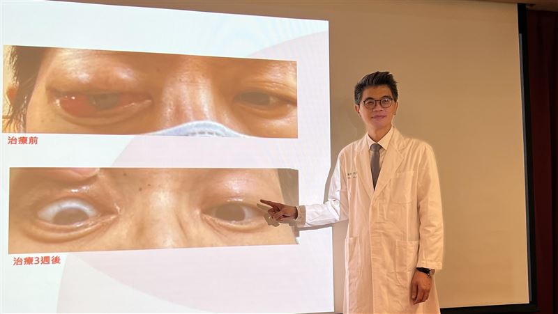 乳癌細胞轉移到眼窩　女子眼球凸出險挖眼