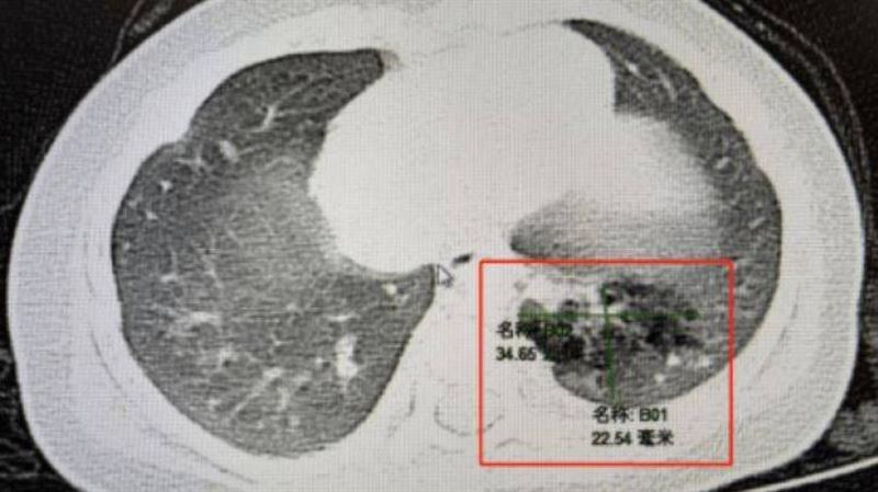 嬰兒咳嗽不止　赫見「多長了1個肺」