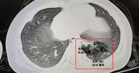 長期狂咳不停！4月嬰罕見體內有「2個肺」(圖/翻攝微博)
