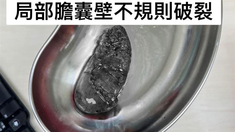 40歲男膽腫如士林大香腸　醫照超音波嚇壞