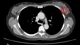 41歲熟女無乳癌家族病史 ，多發性纖維瘤中變乳癌(圖／光田醫院提供)