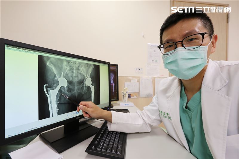 老婦動手術換髖關節仍痠痛　翻修找回腳力