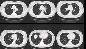 蘇一峰分享一名60歲媽媽滿天星肺結節的病例。（圖／翻攝自蘇一峰臉書）