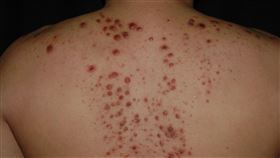 結節性癢疹伴隨嚴重搔癢症狀。（圖／蔡呈芳醫師提供）