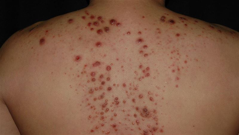 抓一顆癢全身！他「手賤」抓癢爆出百顆疹