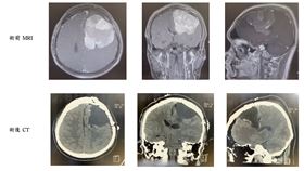 腦瘤摘除手術前後對照圖。（圖／亞東醫院提供）