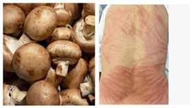 身體出現像是「鞭打後的傷痕」？皮膚科醫師蔡昀臻表示，這可能是「香菇皮膚炎」（組合圖／翻攝自Pixabay／臉書：蔡昀臻醫師）