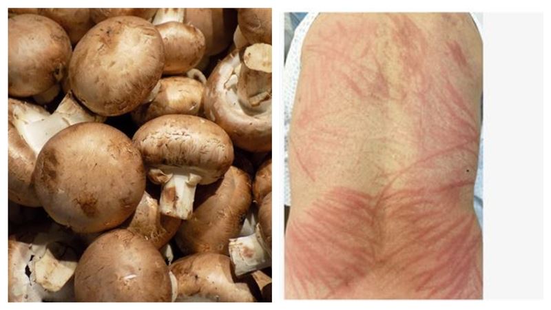 皮膚都是抓痕「像被鞭打」　兇手竟是香菇