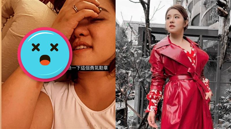 謝依霖疑遭家暴　佈滿瘀青驚人傷勢曝