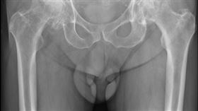 童綜合醫院,骨科部,謝國顯,股骨,缺血性壞死,髖部人工關節,置換手術
圖/童綜合醫院提供