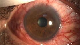 頸動脈海綿竇廔管(豐原醫院提供)