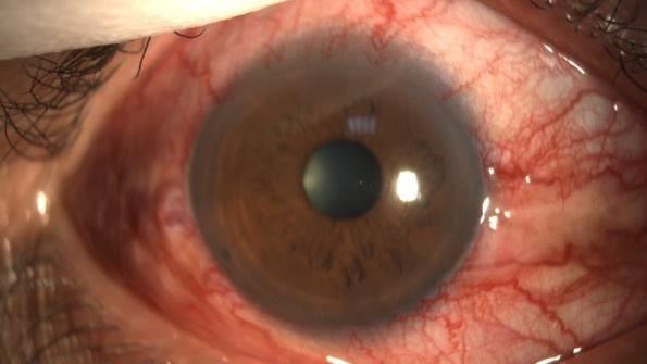 驚悚!螺旋血管「爬」進眼 醫師揪出元凶