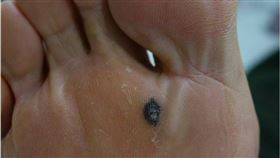 皮膚癌（萬芳醫院提供）