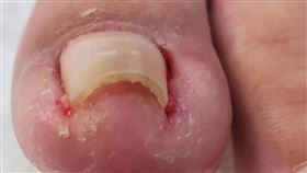 一位50歲男性因修剪腳指甲方式不當，產生卷甲合併甲溝炎症狀。（圖／書田醫院提供）