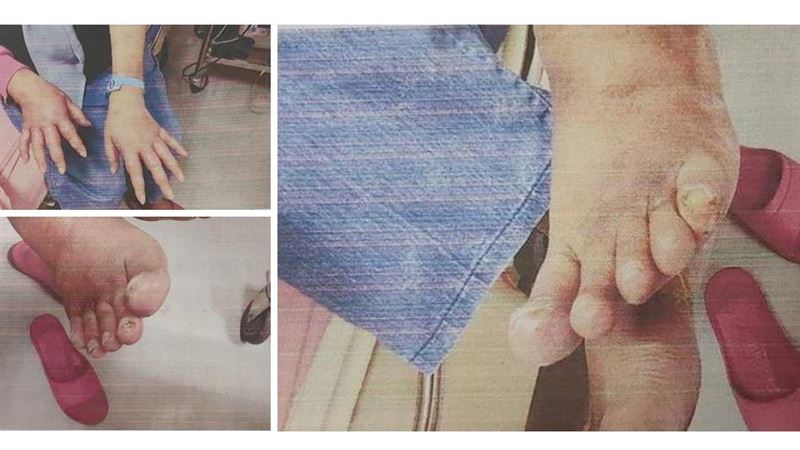 漢生病在台仍未絕跡　印尼資深看護不治