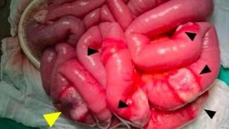 大仁哥罹淋巴癌？醫一看：腸子被癌入侵了