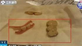 ▲85歲長者口中的多顆牙齒以及一個假牙套竟掉進肺裡致死。（圖／翻攝自荔枝網）