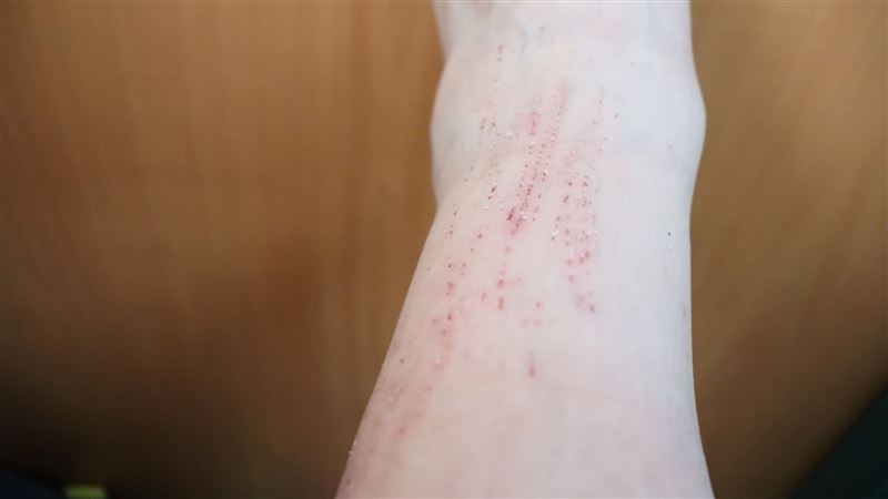 一覺醒來全身「貓抓傷」？竟是身體缺水了